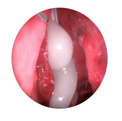 Tampony opatrunkowe (opatrunki donosowe) Cover HemoGel-ENT