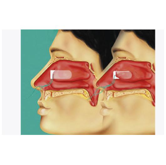 Tampony opatrunkowe (opatrunki donosowe) Lohmann & Rauscher Raucocel K