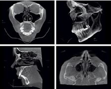 Tomografy komputerowe mobilne Planmed Verity