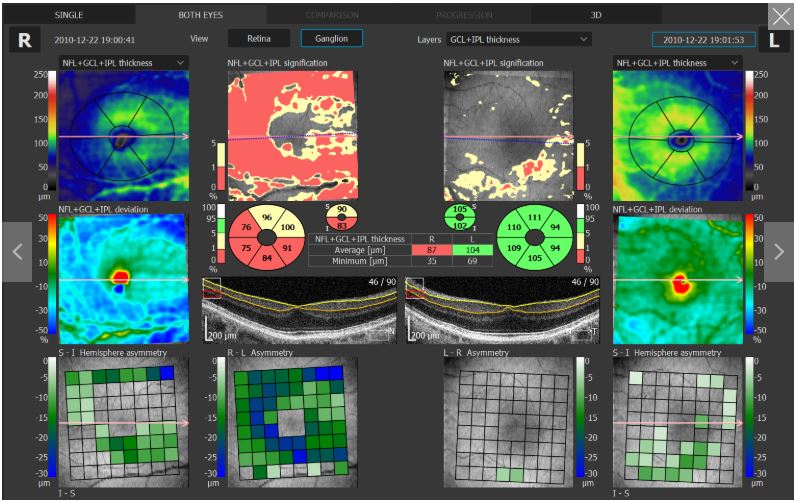 Tomografy okulistyczne (OCT) OPTOPOL REVO 80