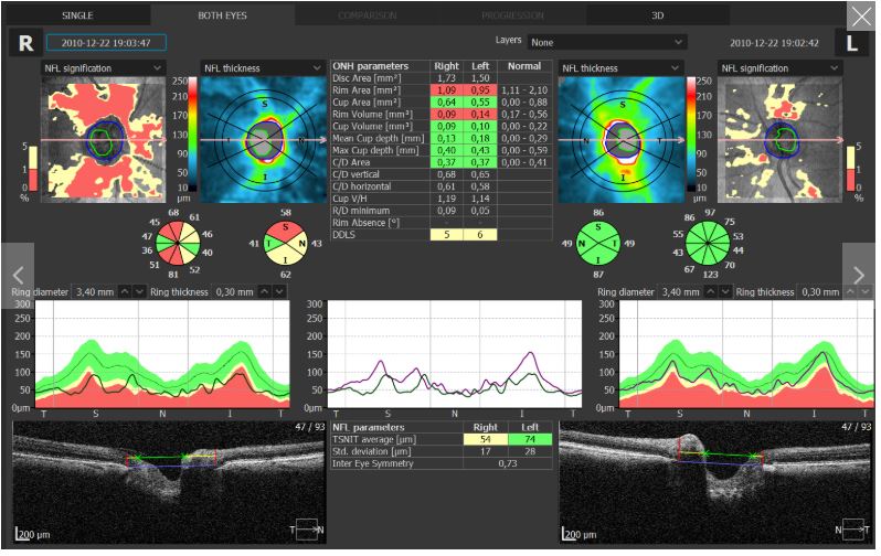 Tomografy okulistyczne (OCT) OPTOPOL REVO 80