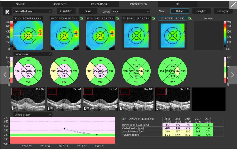 Tomografy okulistyczne (OCT) OPTOPOL REVO 80