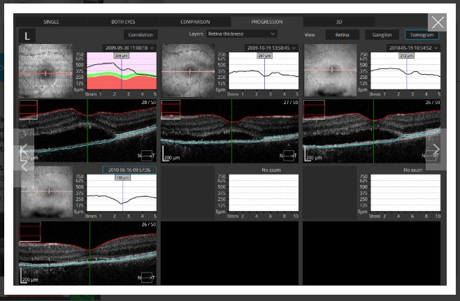 Tomografy okulistyczne (OCT) OPTOPOL REVO 80