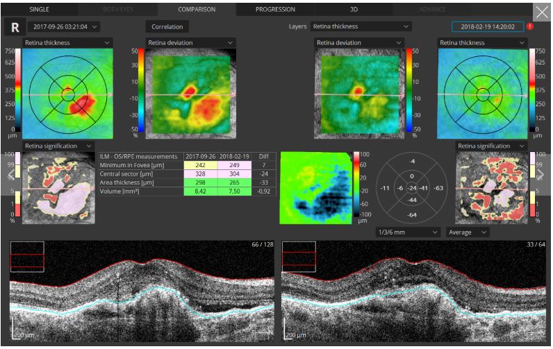 Tomografy okulistyczne (OCT) OPTOPOL REVO NX