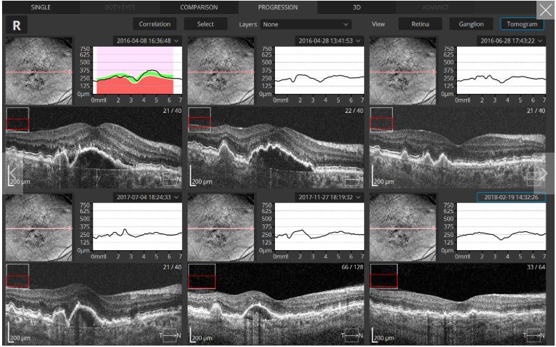 Tomografy okulistyczne (OCT) OPTOPOL REVO NX