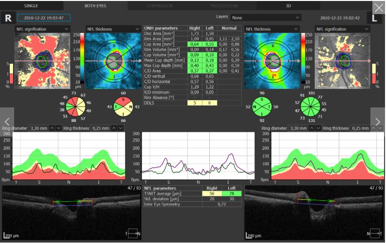 Tomografy okulistyczne (OCT) OPTOPOL REVO NX