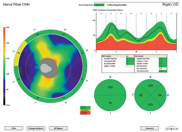 Tomografy okulistyczne (OCT) Optovue iScan80