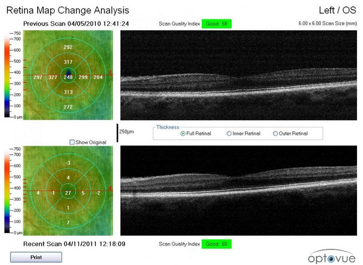 Tomografy okulistyczne (OCT) Optovue RTVue VTRAC Premier