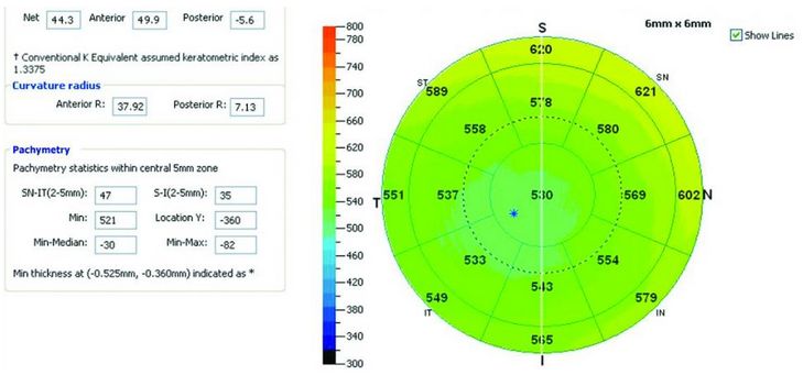 Tomografy okulistyczne (OCT) Optovue RTVue VTRAC Premier