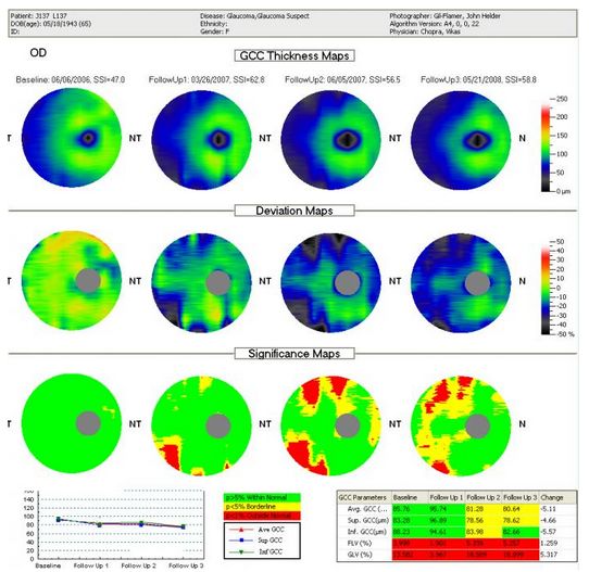 Tomografy okulistyczne (OCT) Optovue RTVue VTRAC Premier