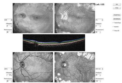 Tomografy okulistyczne (OCT) Optovue RTVue XR AVANTI