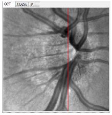 Tomografy okulistyczne (OCT) Optovue RTVue XR AVANTI