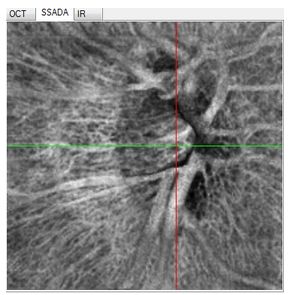Tomografy okulistyczne (OCT) Optovue RTVue XR AVANTI