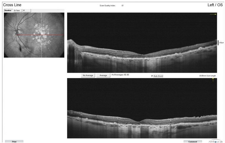 Tomografy okulistyczne (OCT) Optovue RTVue XR AVANTI