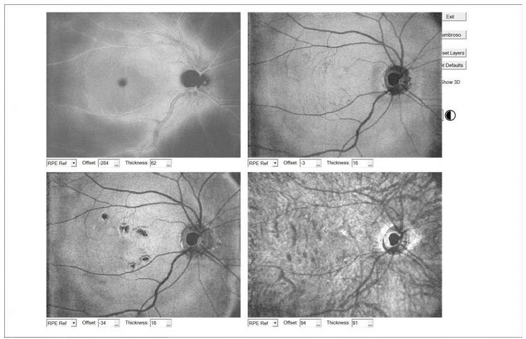 Tomografy okulistyczne (OCT) Optovue RTVue XR AVANTI