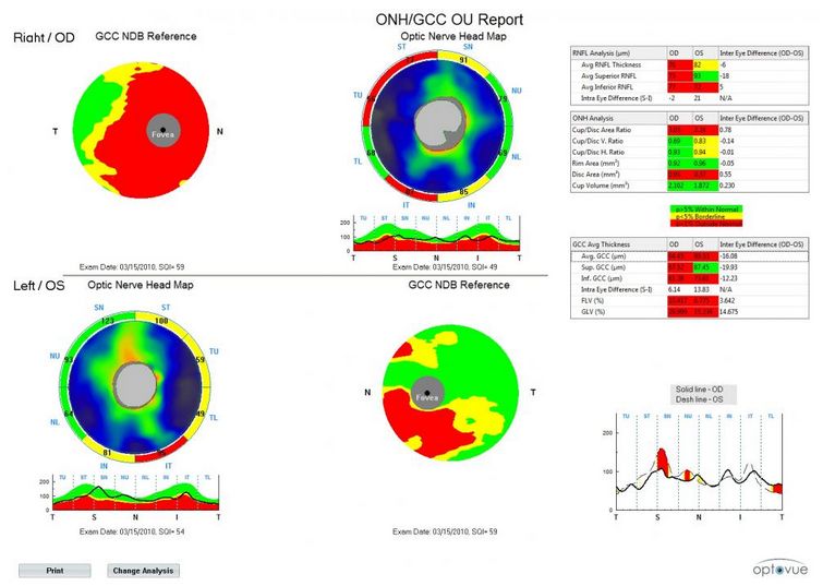 Tomografy okulistyczne (OCT) Optovue RTVue XR AVANTI