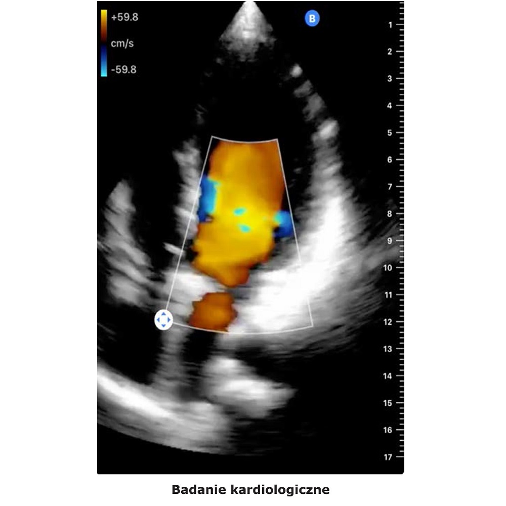Ultrasonografy kieszonkowe ręczne (USG) Butterfly iQ+