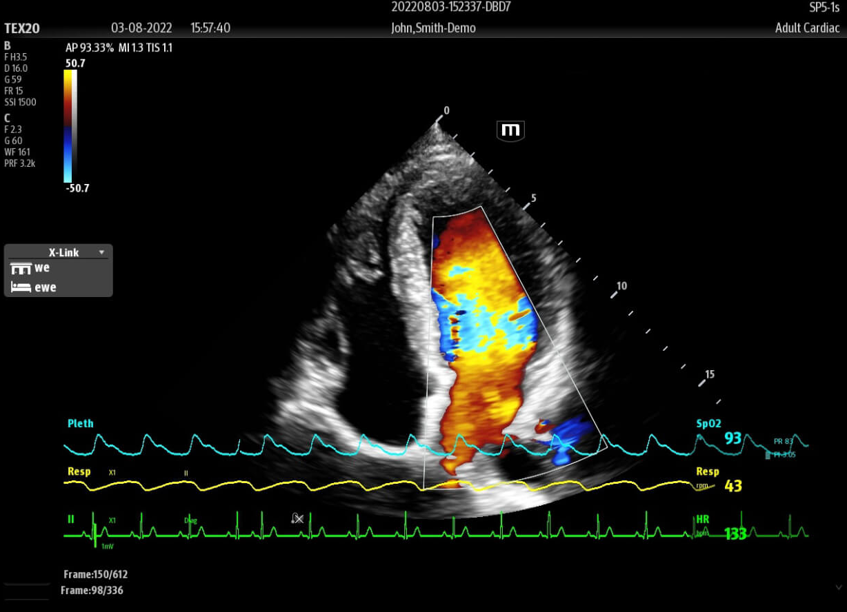 Ultrasonografy mobilne przyłóżkowe MINDRAY TEX20