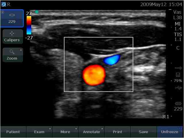 Ultrasonografy mobilne przyłóżkowe SonoSite NanoMaxx