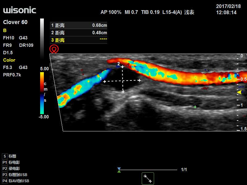 Ultrasonografy mobilne przyłóżkowe Wisonic Clover 60