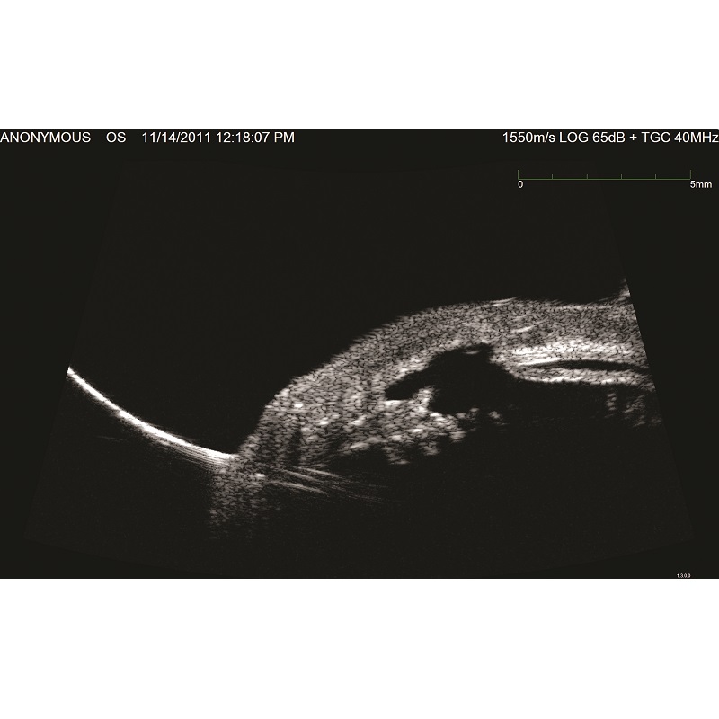 Ultrasonografy okulistyczne Ellex Eye Cubed