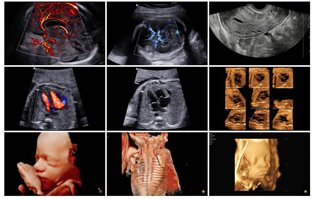 Ultrasonografy stacjonarne wielonarządowe - USG Samsung HERA W9