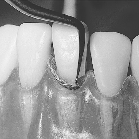 Upychadła stomatologiczne LM-Instruments Upychacz nitki retrakcyjnej