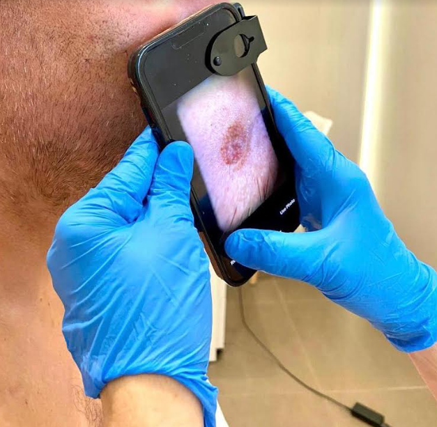 Videodermatoskopy Neviscope Neviscope