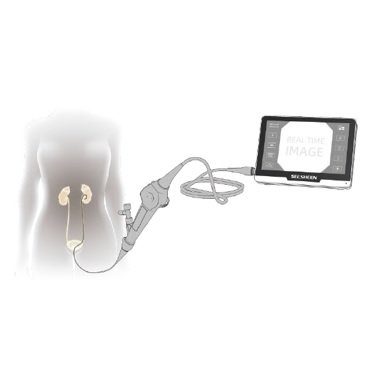Videoureteroskopy Seesheen UR‐1328