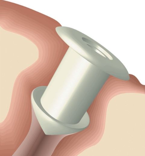 Zatyczki do kanalików łzowych Oasis Zatyczki do kanalików łzowych