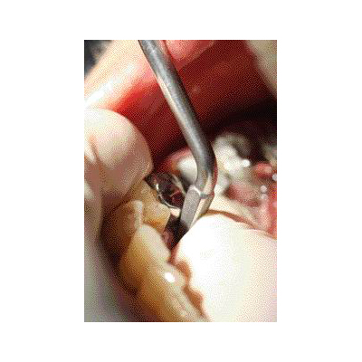 Zbijaki automatyczne do zdejmowania koron Anthogyr Safe Relax