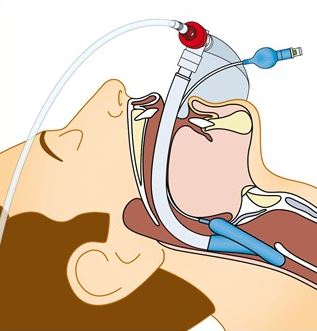 Zestawy do podawania tlenu do intubacji Flexicare Medical 032-10-540 / 032-10-640 / 032-10-740
