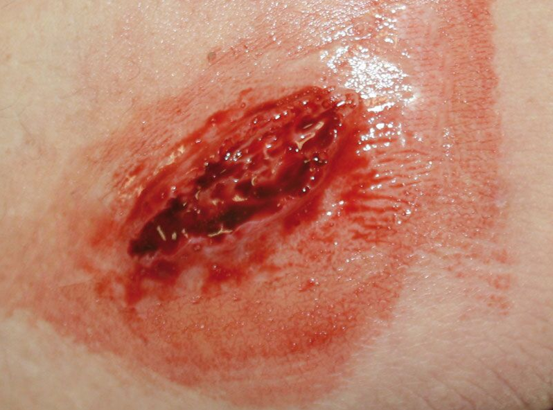 Zestawy do pozoracji ran 3B Scientific WS01