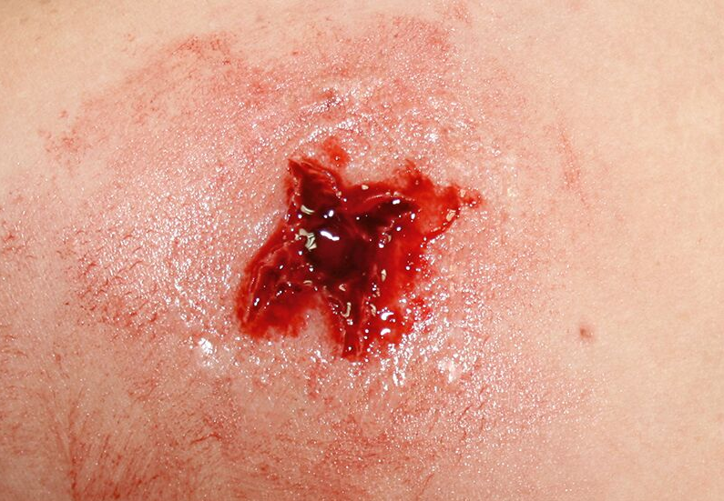 Zestawy do pozoracji ran 3B Scientific WS02