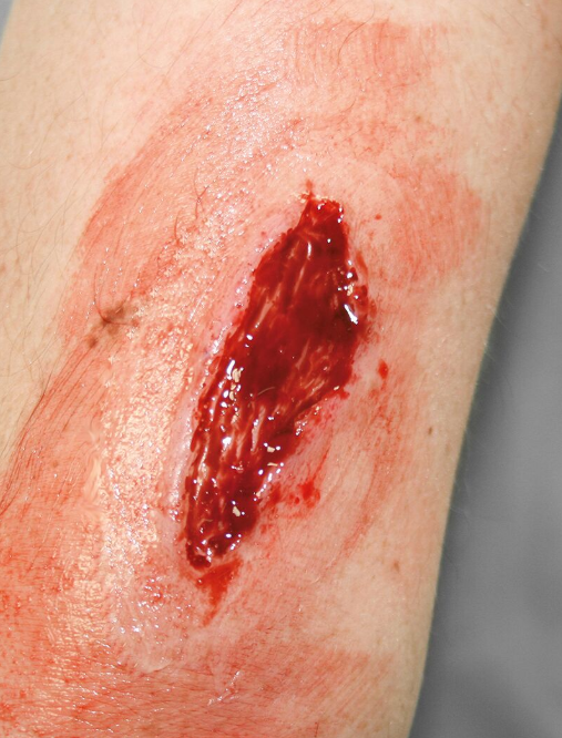 Zestawy do pozoracji ran 3B Scientific WS02