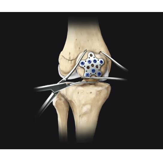 Płytki do leczenia złamań rzepki do artroskopii