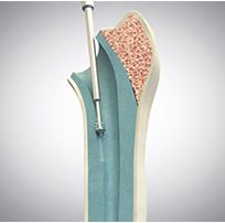 Systemy do zabiegów rewizyjnych