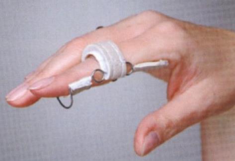 Ortezy i stabilizatory palców