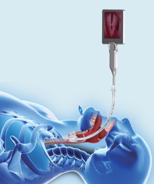 Videoprowadnice do trudnej intubacji